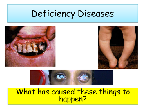 deficiency-diseases-by-nparkie0-teaching-resources-tes