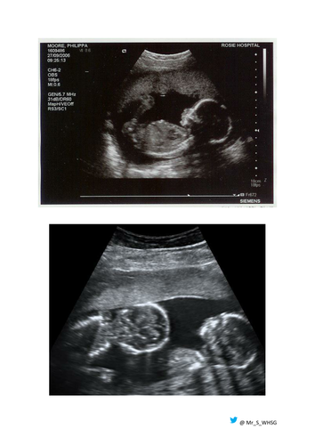 Variety of baby scan images for twins and reproduction