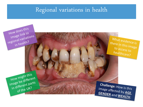 Regional Variation in Health - AS Geography AQA