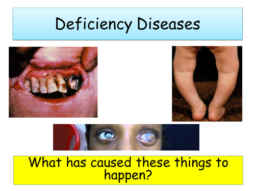 Deficiency Diseases