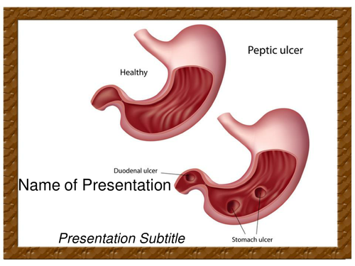 Peptic Ulcer PPT Template