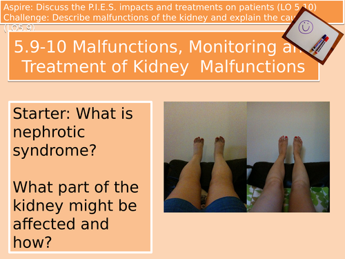 LO5.9-10 (4 of 5) Kidney Malfunctions and Care Options Level 3 Unit 4 Cambridge Technicals Health