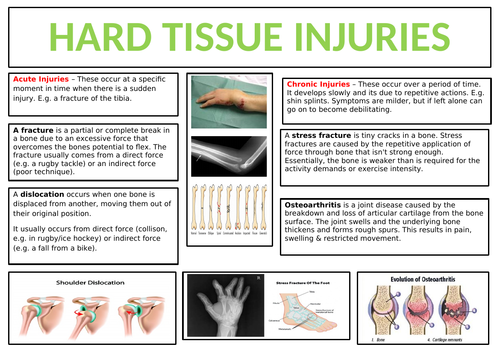 A2 OCR (New Spec 2016 +) Physical Education Exercise Physiology Injuries Revision Broadsheets
