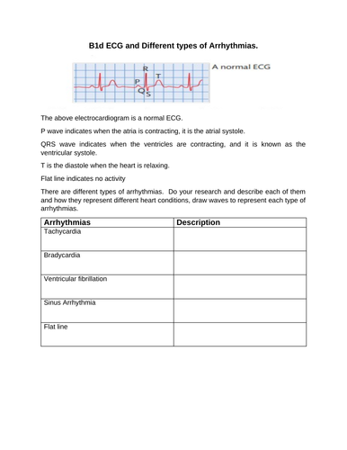 U5 B1d ECG and Arrhythmias