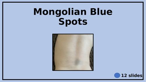 Mongolian Blue Spots - Congenital dermal melanocytosis - Bruises or not?