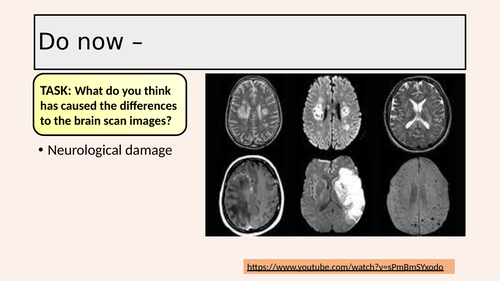Edexcel GCSE Psychology - The Brain and Neuropsychology - The impact of neurological damage
