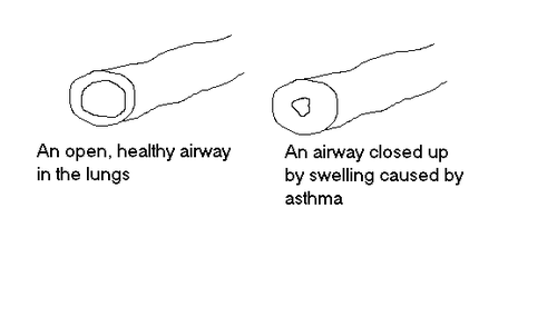 asthma blockage