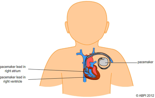 Artificial Pacemaker