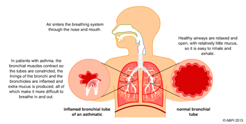 Asthma - Bronchioles