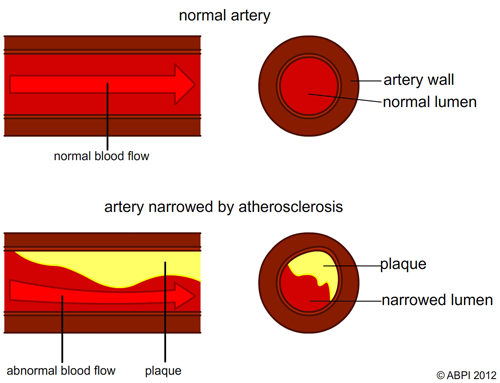 Atherosclerosis