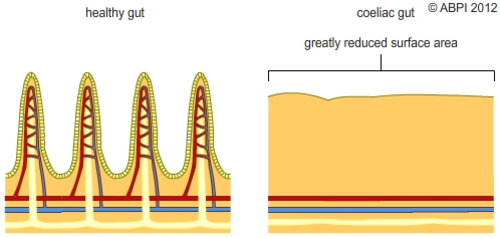 Coeliac Disease