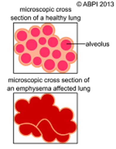 Emphysema & Alveoli