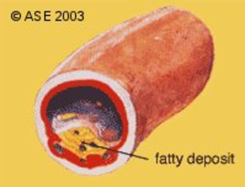Fatty Deposits in Artery