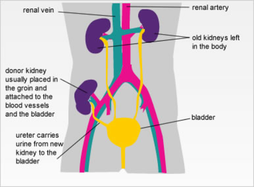 Kidney Transplant | Teaching Resources
