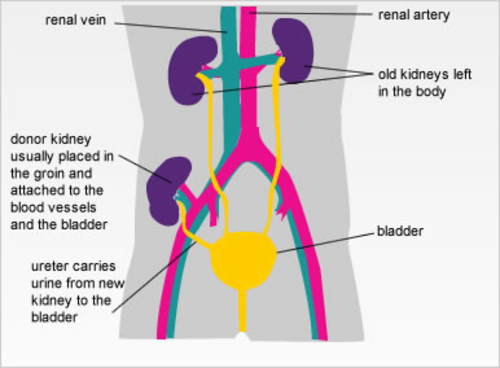 Kidney Transplant